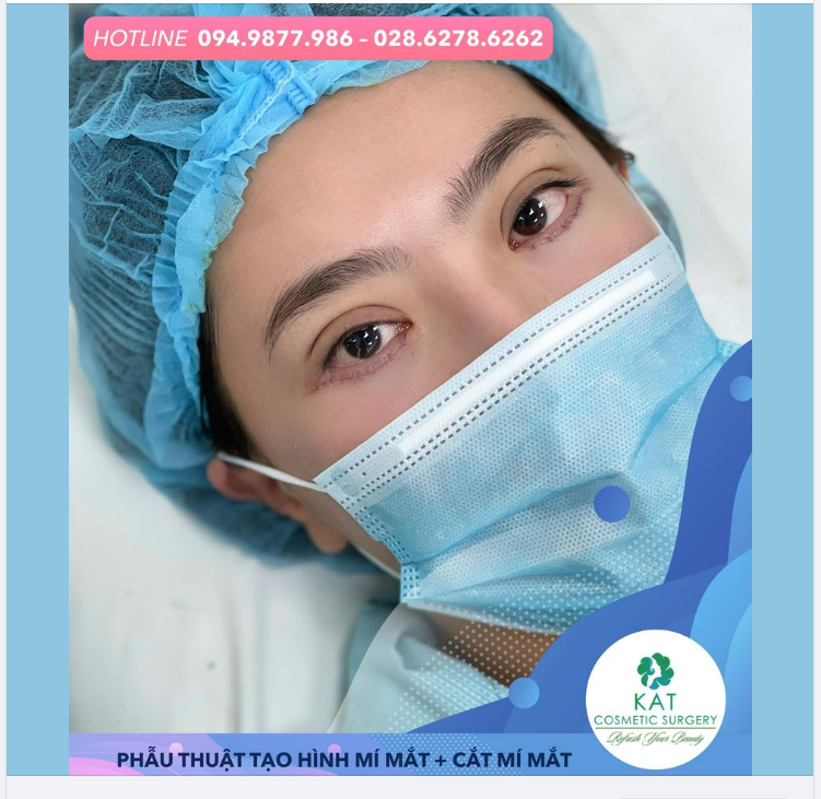 “Điều kì diệu của combo bấm mí, cắt mí mắt dưới  ”