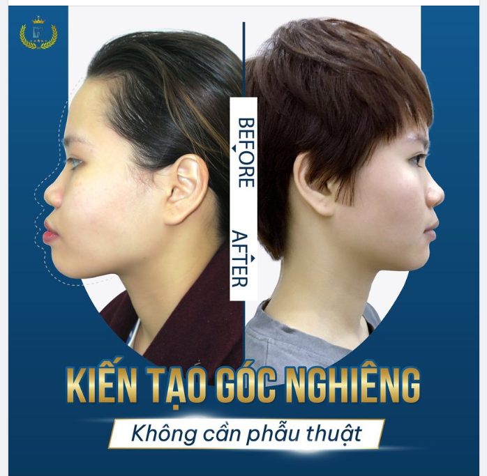 ĐIỀU TRỊ HÔ HÀM KHÔNG CẦN PHẪU THUẬT