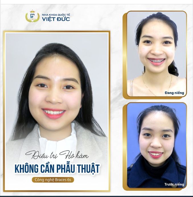 ĐOẠN TUYỆT ÁM ẢNH RĂNG HÔ