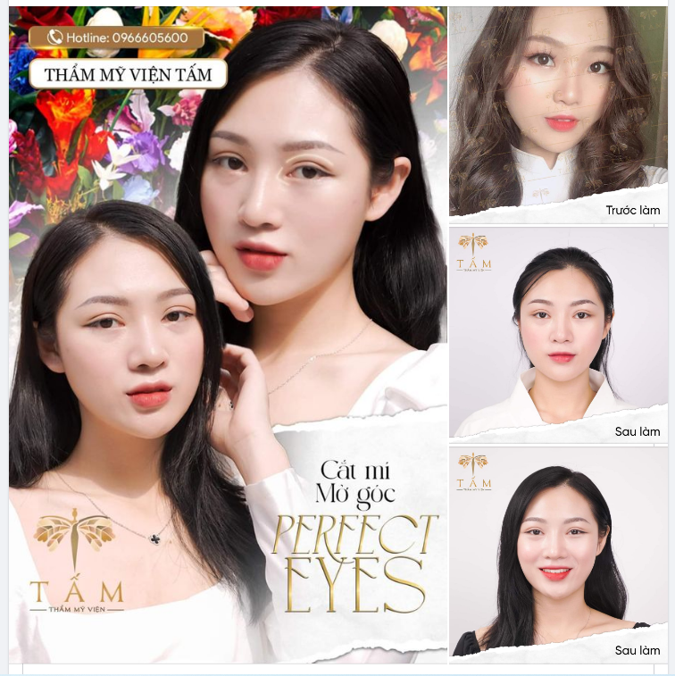 Đôi mắt sau hơn 2 tháng của khách hàng khi thực hiện Full Combo Cắt mí + mở góc Perfect Eyes tại TMV Tấm.