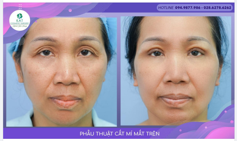 “Đôi mắt tuy dư nhưng lại thiếu “