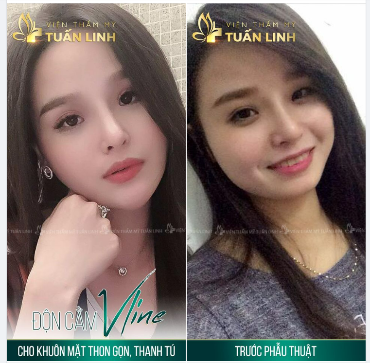 ĐỘN CẰM VLINE - CHO KHUÔN MẶT THON GỌN - ĐẸP THANH TÚ.