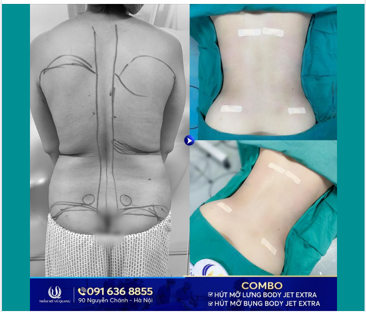 Dọn mỡ gọn gàng - Vóc dáng đẹp sang