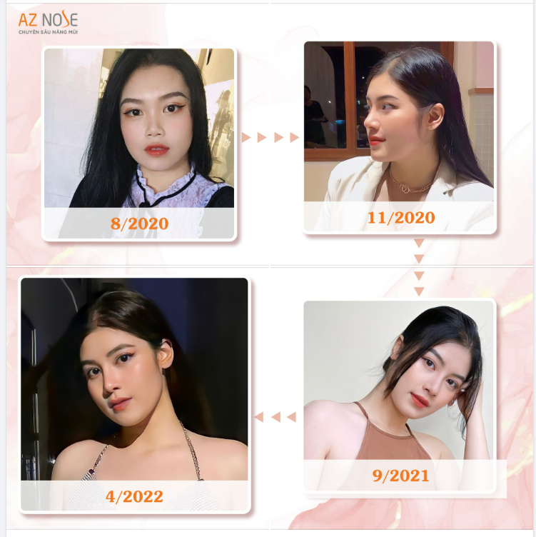 Em đi học gặp bạn bè ai cũng khen mũi đẹp mà nhìn tự nhiên