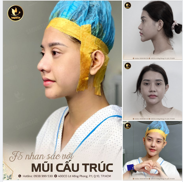“F5” NHAN SẮC SAU NÂNG MŨI CẤU TRÚC TẠI DR. HOẠT