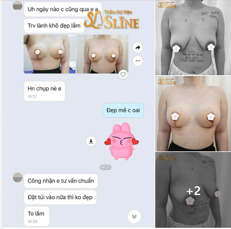 FEEBACK thực tế của 1 bạn khách hàng treo sa trễ cấp độ 4 với Ekip Thẩm Mỹ Viện Sline không đặt túi, kết quả sau 7 ngày .