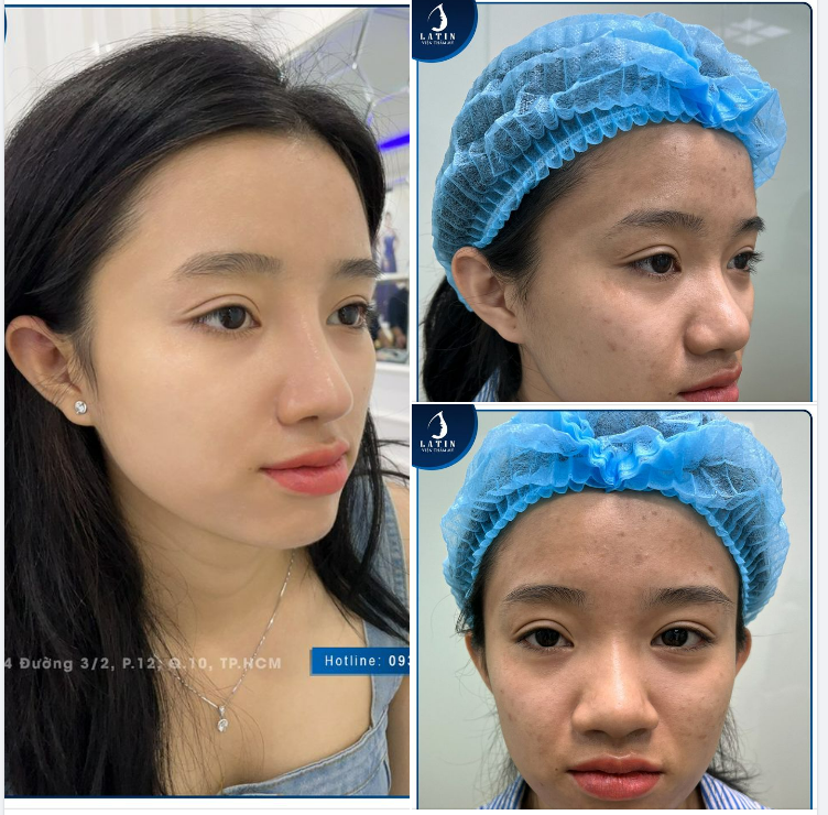 FEEDBACK Mũi bán cấu trúc sau 10 ngày