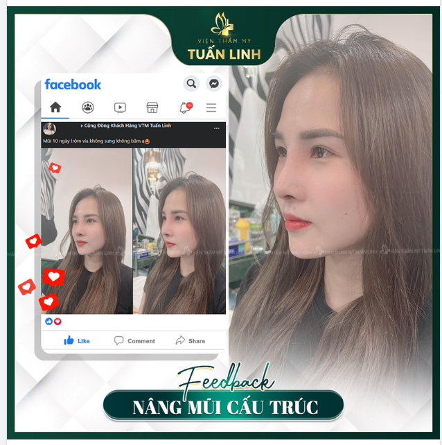 FEEDBACK MŨI ĐẸP TỰ NHIÊN SAU 10 NGÀY!!!