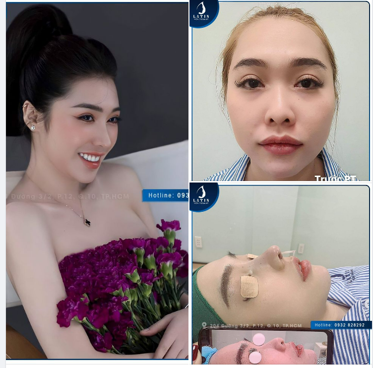 FEEDBACK MŨI SỬA LẠI TÁI CẤU TRÚC SAU 2 NĂM