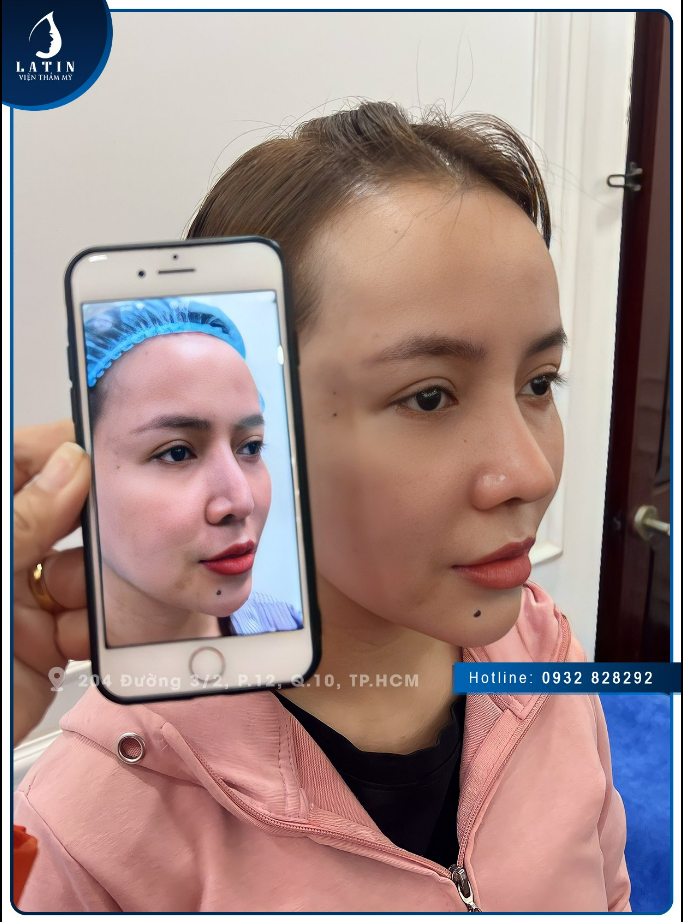 FEEDBACK Mũi tái cấu trúc sau 3 tuần