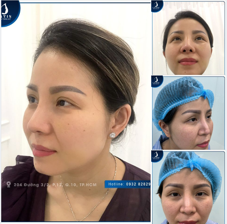 FEEDBACK Mũi tái cấu trúc sửa lại lần 3