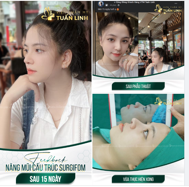 FEEDBACK NÂNG MŨI CẤU TRÚC SURGIFORM SAU 15 NGÀY!!!