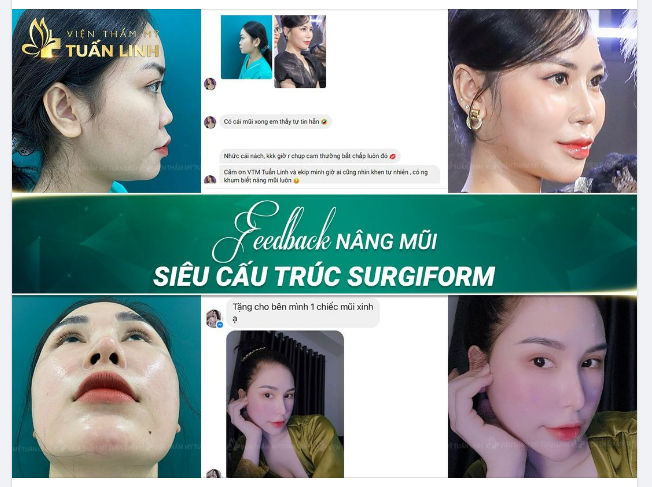 FEEDBACK NÂNG MŨI SIÊU CẤU TRÚC SURGIFORM