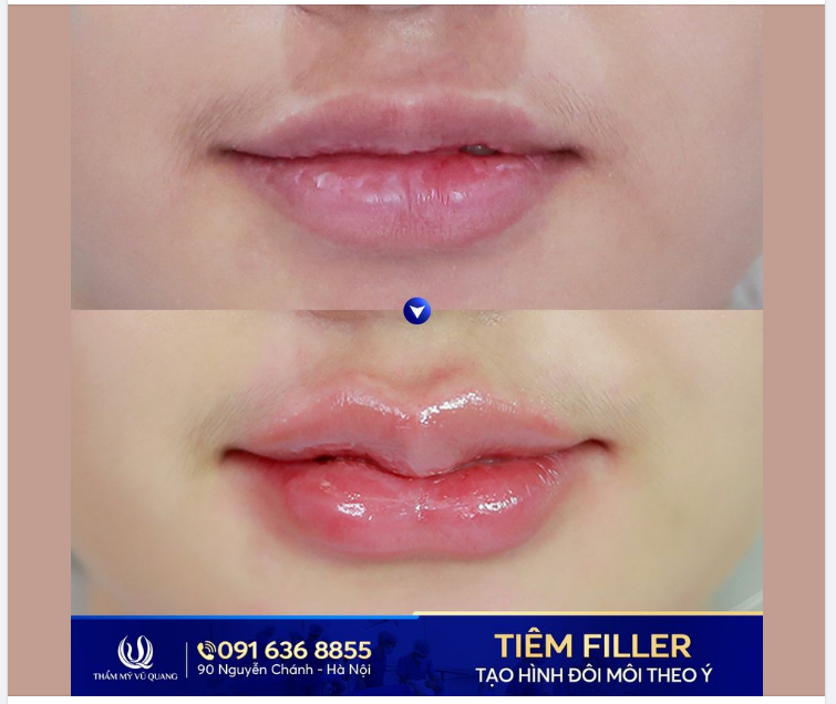 Filler cao cấp - Đẹp cấp tốc