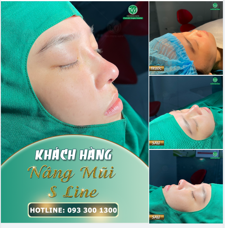 FORM MŨI S LINE ĐẸP HOÀN HẢO CHO KHUÔN MẶT THÊM NỔI BẬT