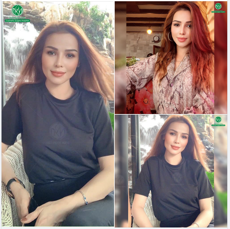 FORM MŨI S LINE ĐẸP HOÀN HẢO