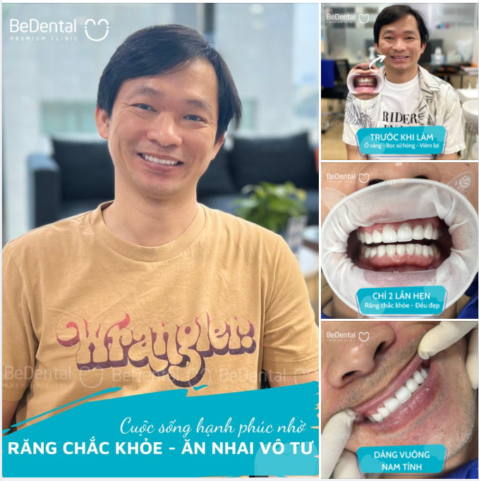 Giải cứu bọc sứ hỏng gây hôi miệng cho kh nam ở Sài Gòn