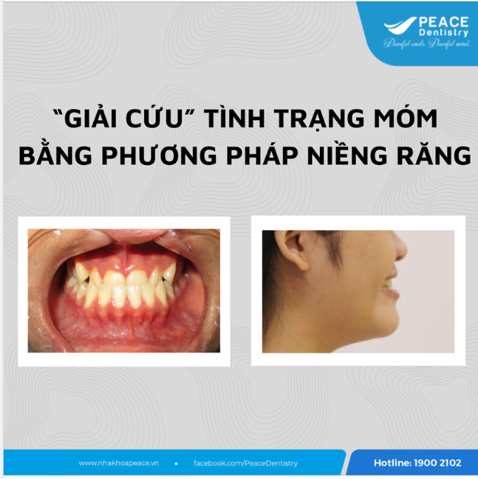 “GIẢI CỨU” TÌNH TRẠNG MÓM BẰNG PHƯƠNG PHÁP CHỈNH NHA NIỀNG RĂNG
