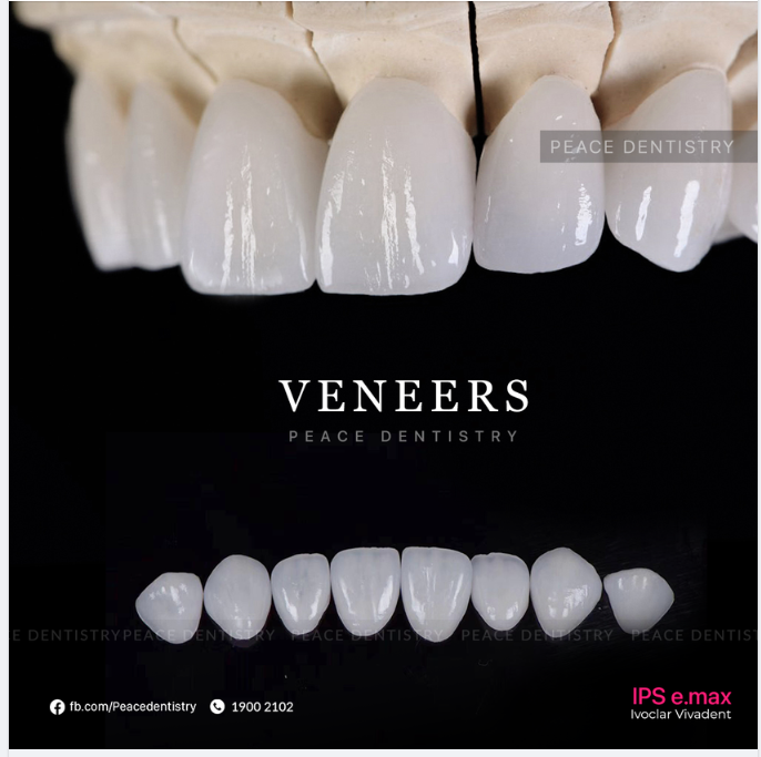GIẢI ĐÁP NHỮNG CÂU HỎI PHỔ BIẾN VỀ MẶT DÁN SỨ VENEER
