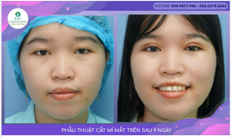 “ Giải pháp cho đôi mắt sụp mí ở người trẻ tuổi “