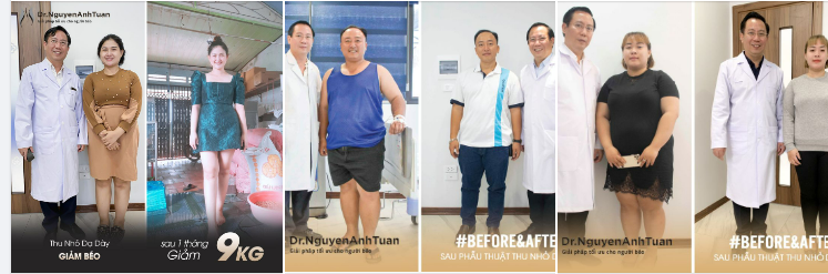 Giảm cân thành công sau thu nhỏ dạ dày là cảm giác thế nào