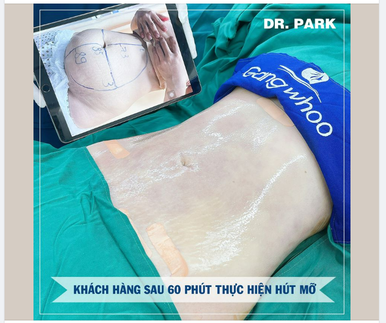GIẢM MỠ BỤNG – VÌ SAO PHẢI LÀ LIPO ULTRASOUND