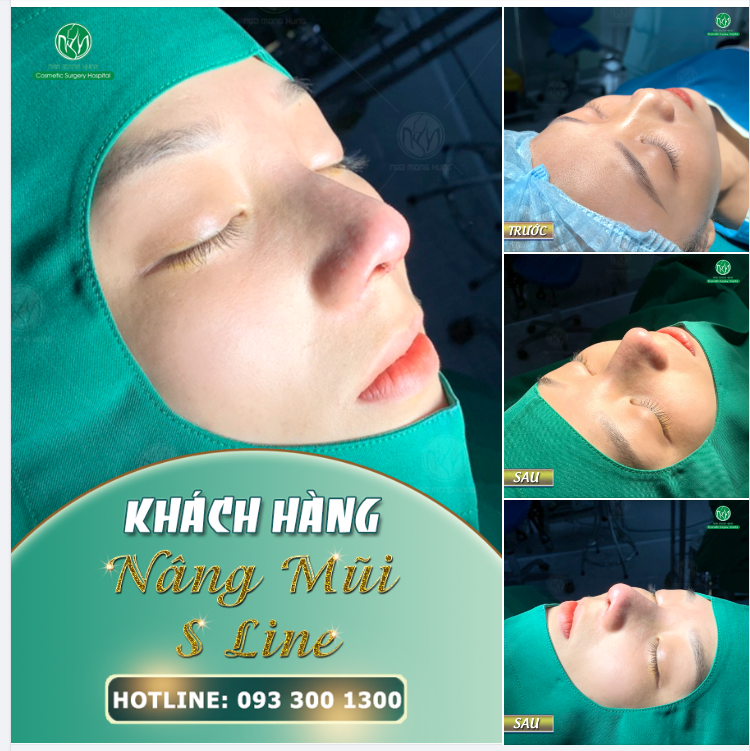 GƯƠNG MẶT SẮC NÉT VỚI DÁNG MŨI S LINE