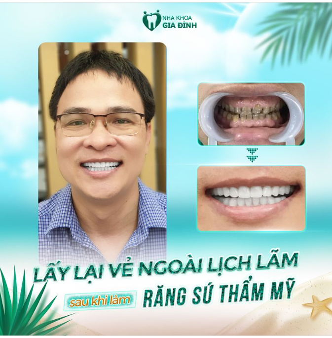 HÀM RĂNG ĐEN, XỈN MÀU SẼ KHIẾN NGƯỜI ĐÀN ÔNG THIẾU CHỈN CHU KHI GIAO TIẾP