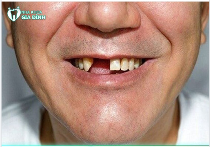 HẬU QUẢ KHI MẤT RĂNG Ở NGƯỜI LỚN