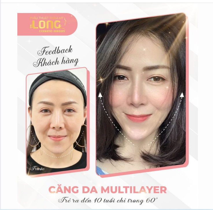 Hãy trải nghiệm công nghệ “CĂNG DA MẶT PHẪU THUẬT” Giải cứu làn da kịp thời chỉ sau 1 lần thực hiện TRẺ RA 5-10 TUỔI.