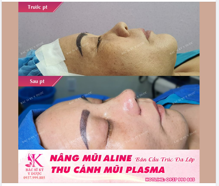 Hiện nay, phương pháp nâng mũi kết hợp thu gọn cánh mũi chính là giải pháp phù hợp nhất, giúp khắc phục những hạn chế hai bên cánh mũi vô cùng hiệu quả.