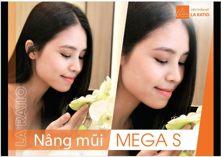 Hiểu Về Nâng Mũi Cấu Trúc Mega S