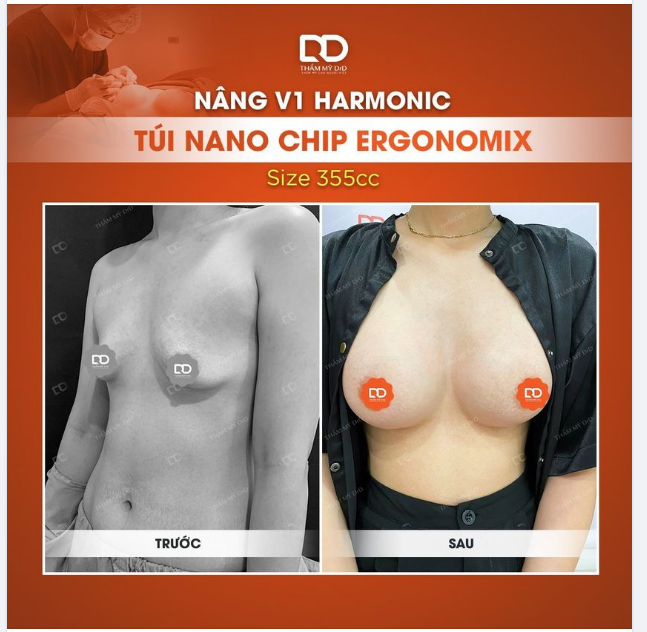 HÌNH ẢNH KẾT QUẢ SAU 1 THÁNG PHẪU THUẬT NÂNG V1