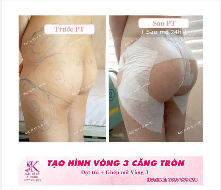 Hình ảnh khách hàng Đặt túi kết hợp Cấy mỡ tạo hình mông tại Thẩm Mỹ Bác Sĩ Kỳ Y Dược​​​​​​​ sau 24h phẩu thuật.