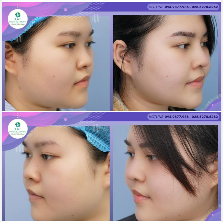  Hình ảnh người thật việc thật của KAT sẽ cho bạn thấy một dáng mũi đẹp có thể giúp gương mặt bạn toả sáng và rạng rỡ đến không ngờ.