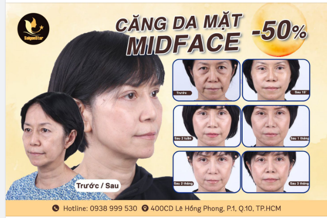 Hình ảnh rạng rỡ, trẻ đẹp của chị khách sau 3 tháng CĂNG DA MIDFACE tại Dr Hoạt