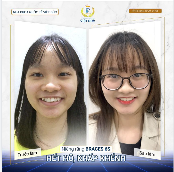 HÔ - KHẤP KHỂNH, ĐỪNG LO, NIỀNG RĂNG LÀ HẾT!!!