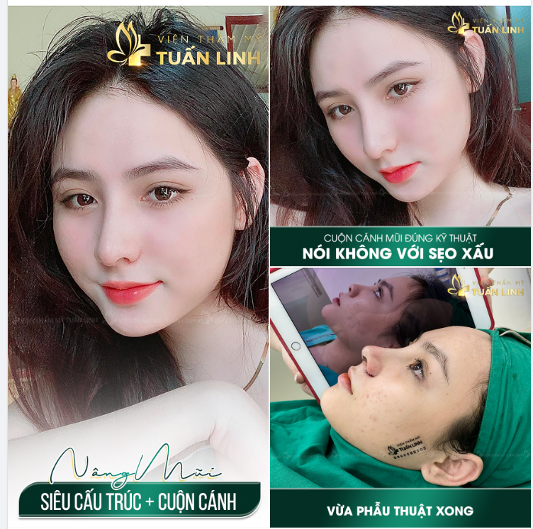 HÓA HOTGIRL XINH ĐẸP SAU NÂNG MŨI SIÊU CẤU TRÚC + CUỘN CÁNH