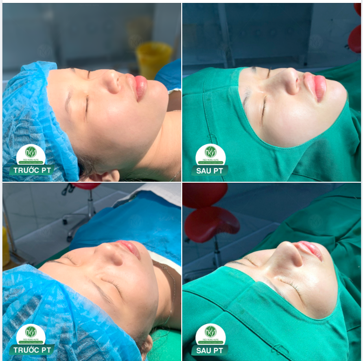 HOÀN THÀNH CA NÂNG MŨI MEGADERM CHO KH 22 TUỔI