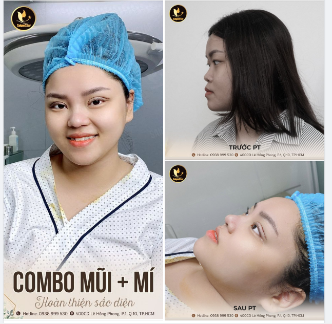 HOÀN THIỆN SẮC DIỆN COMBO NÂNG MŨI + CẮT MÍ