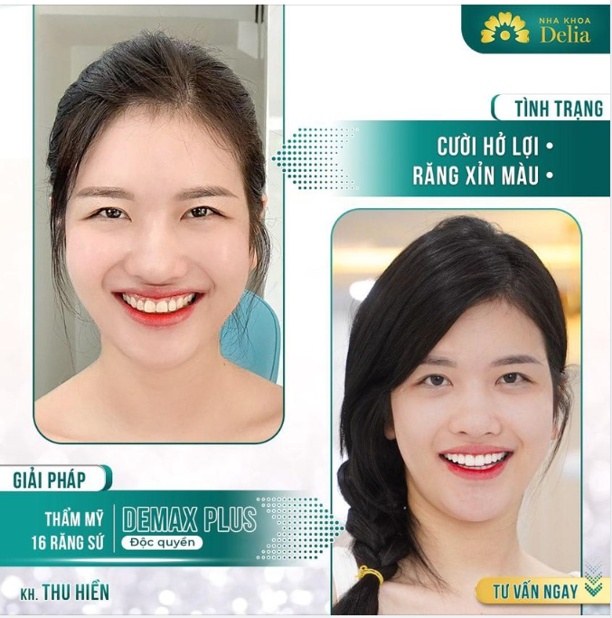 Hotgirl Thu Hiền "lột xác" nụ cười mới - Hết xỉn màu, men răng yếu, khấp khểnh