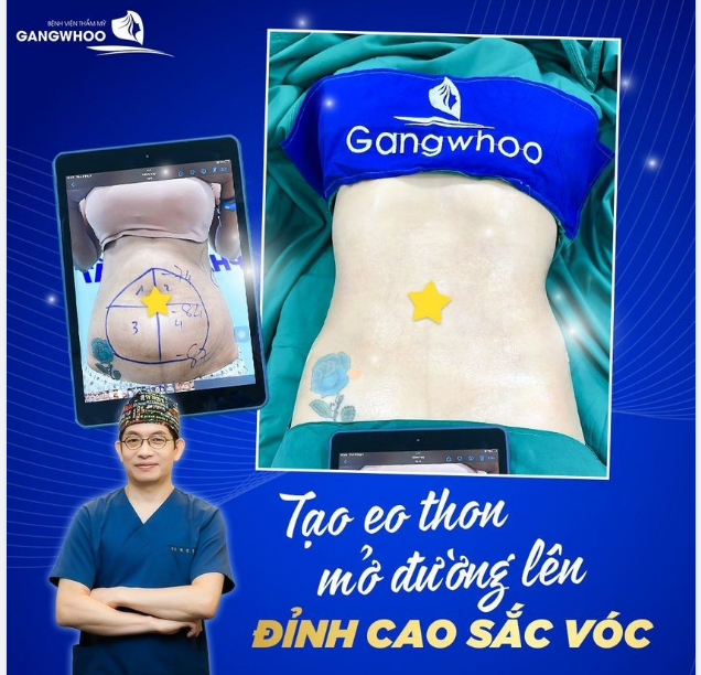HÚT MỠ BỤNG NỘI SOI CÓ AN TOÀN KHÔNG