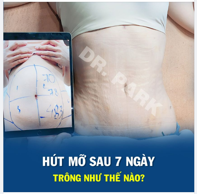 HÚT MỠ BỤNG SAU 7 NGÀY SẼ NHƯ THẾ NÀO
