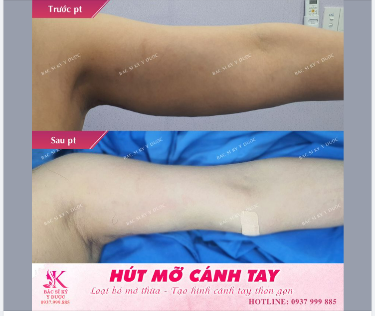 HÚT MỠ CÁNH TAY chưa bao giờ hết HOT