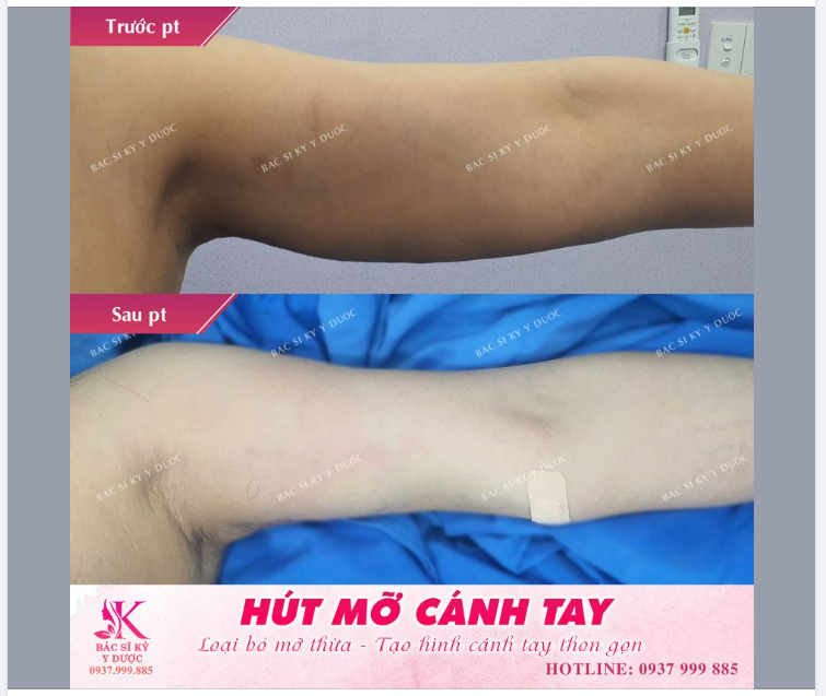 HÚT MỠ CÁNH TAY - GIẢI PHÁP CHO CÁCH TAY NHIỀU MỠ THỪA VÀ DA TRÙNG