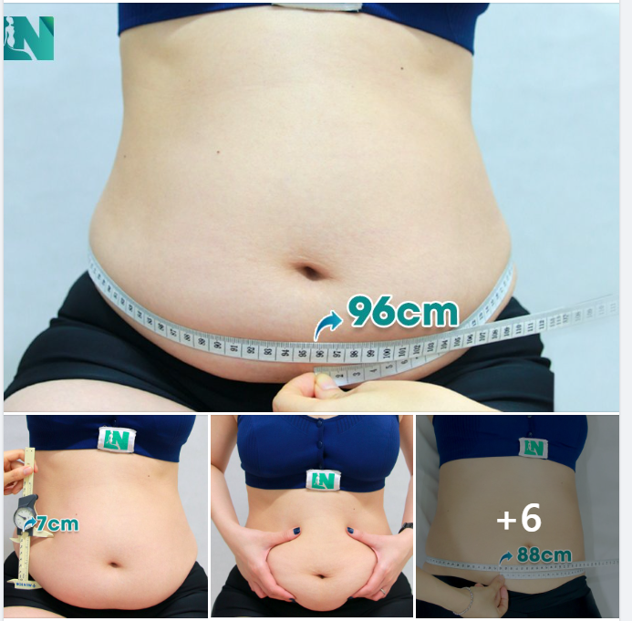  HÚT MỠ TẠO DÁNG THẨM MỸ BỤNG, KẾT HỢP  CẤY MỠ TRẺ HÓA KHUÔN MẶT - LẤY LẠI SẮC VÓC CHO CHỊ KH 37 TUỔI.