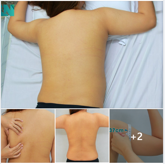  HÚT MỠ TẠO DÁNG THẨM MỸ CHO CHỊ KH 29 TUỔI