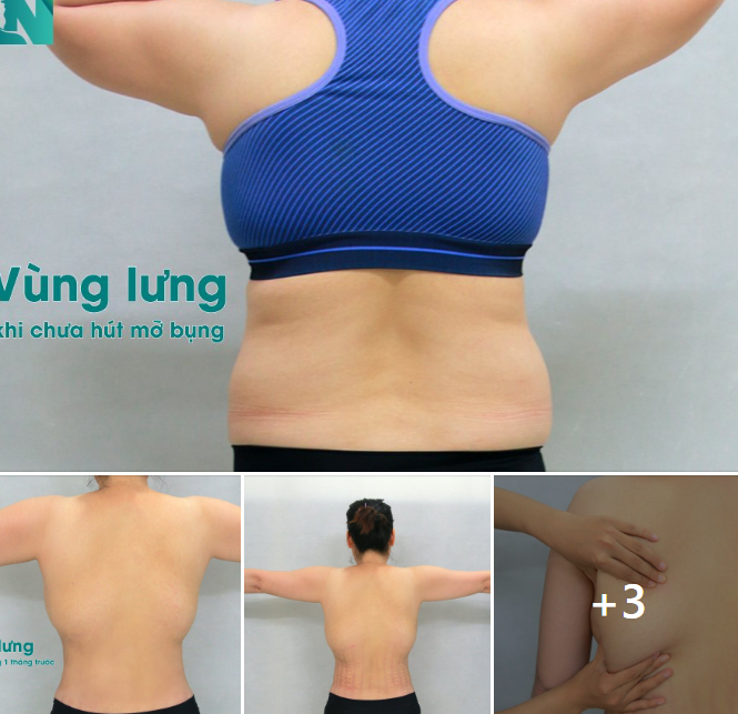 HÚT MỠ TẠO DÁNG THẨM MỸ TAY, LƯNG, NÁCH CHO CHỊ KH 35 TUỔI,