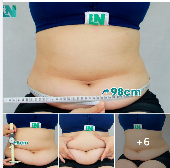  HÚT MỠ TẠO DÁNG THẨM MỸ, TRỞ LẠI VÒNG EO THANH XUÂN CHO CHỊ KH 35 TUỔI SAU SINH: