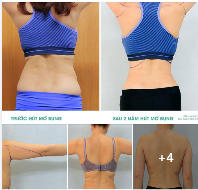  HÚT MỠ TẠO DÁNG THẨM MỸ VÙNG TAY, LƯNG, NÁCH CHO CHỊ KH 45 TUỔI, ĐÃ HÚT MỠ BỤNG TẠI EKIP 2 NĂM TRƯỚC. 